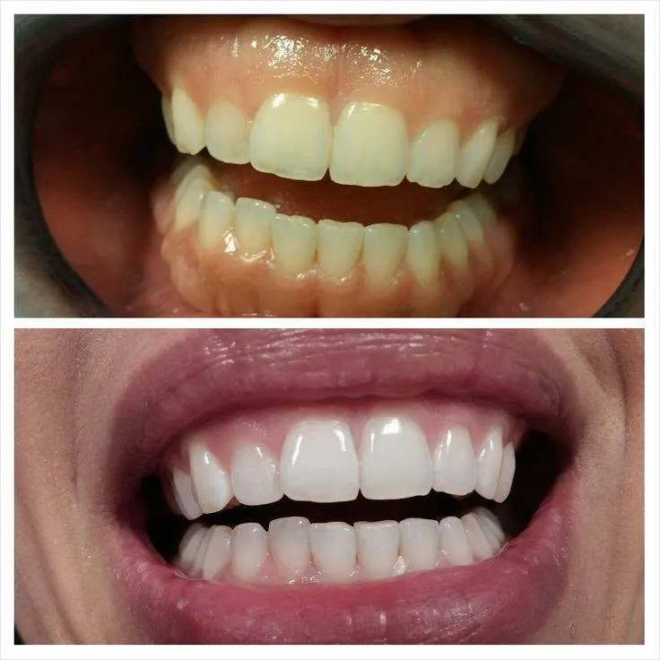 Illustration du blanchiment des dents